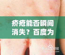 疥疮能否瞬间消失？百度为你解答